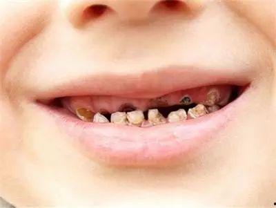 成人拔蛀牙视频文案图片,揭秘成人拔蛀牙全过程